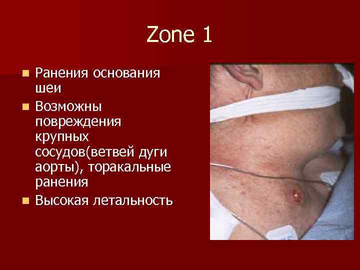 Zone 1 Ранения основания шеи n Возможны повреждения крупных сосудов(ветвей дуги аорты), торакальные ранения