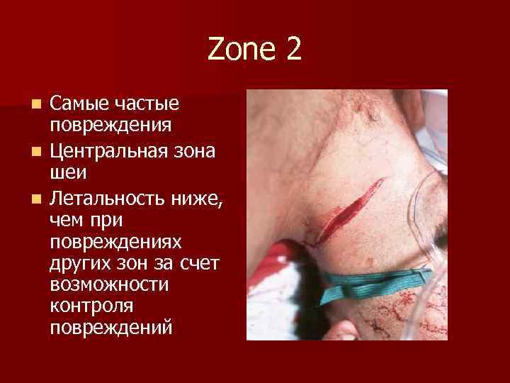 Zone 2 Самые частые повреждения n Центральная зона шеи n Летальность ниже, чем при