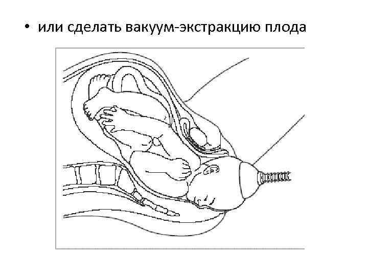 Презентация акушерские щипцы и вакуум экстракция плода