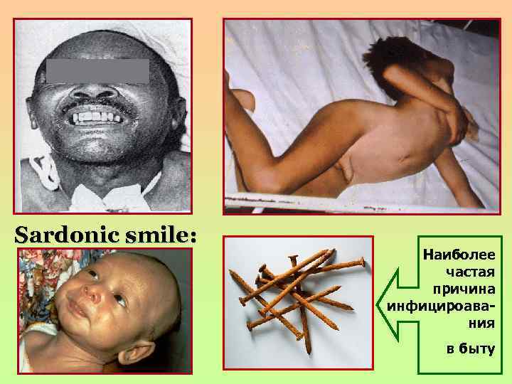 Sardonic smile: Наиболее частая причина инфицироавания в быту 