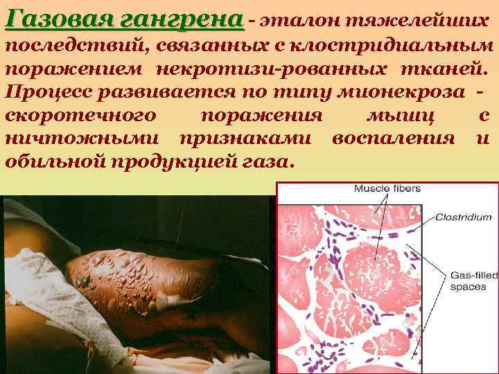 Газовая гангрена - эталон тяжелейших последствий, связанных с клостридиальным поражением некротизи-рованных тканей. Процесс развивается
