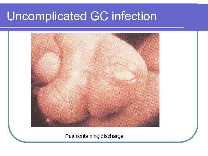 Uncomplicated GC infection Pus containing discharge 