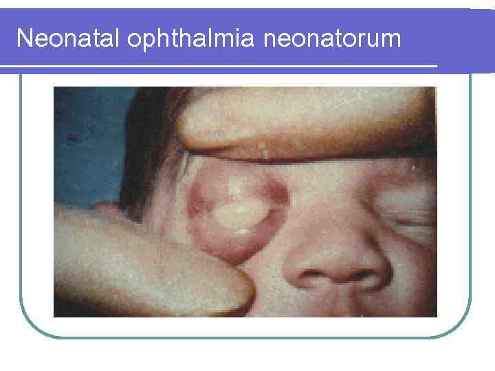 Neonatal ophthalmia neonatorum 