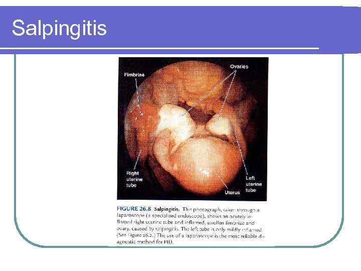 Salpingitis 