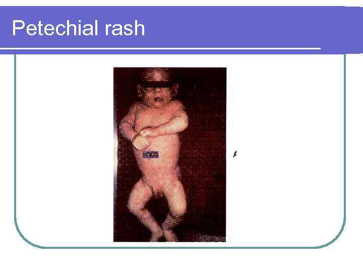 Petechial rash 