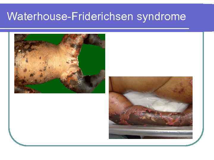 Waterhouse Friderichsen syndrome 