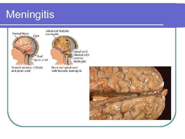Meningitis 