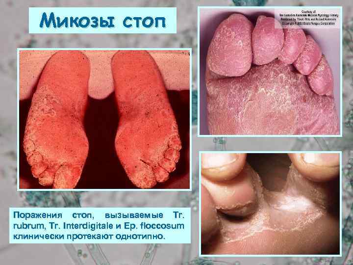 Микозы стоп Поражения стоп, вызываемые Tr. rubrum, Tr. Interdigitale и Ep. floccosum клинически протекают