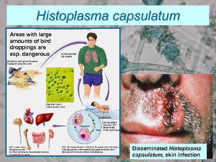 Histoplasma capsulatum Areas with large amounts of bird droppings are esp. dangerous Disseminated Histoplasma