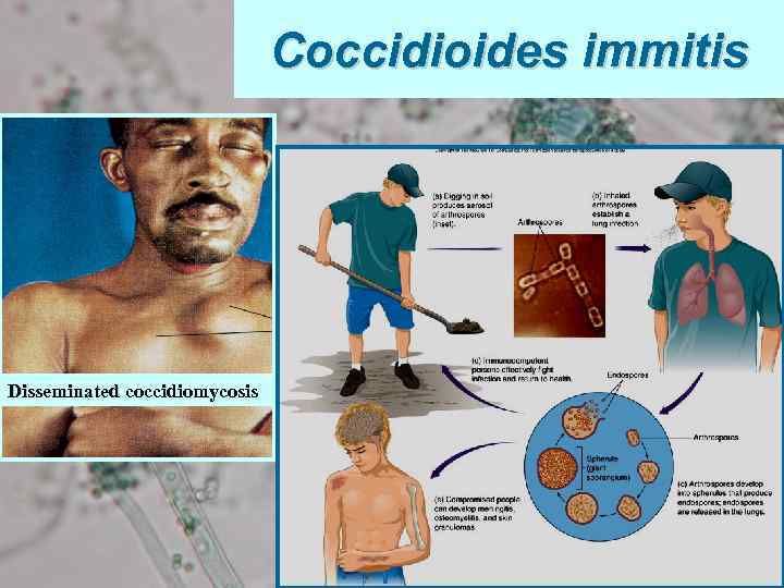 Coccidioides immitis Disseminated coccidiomycosis 