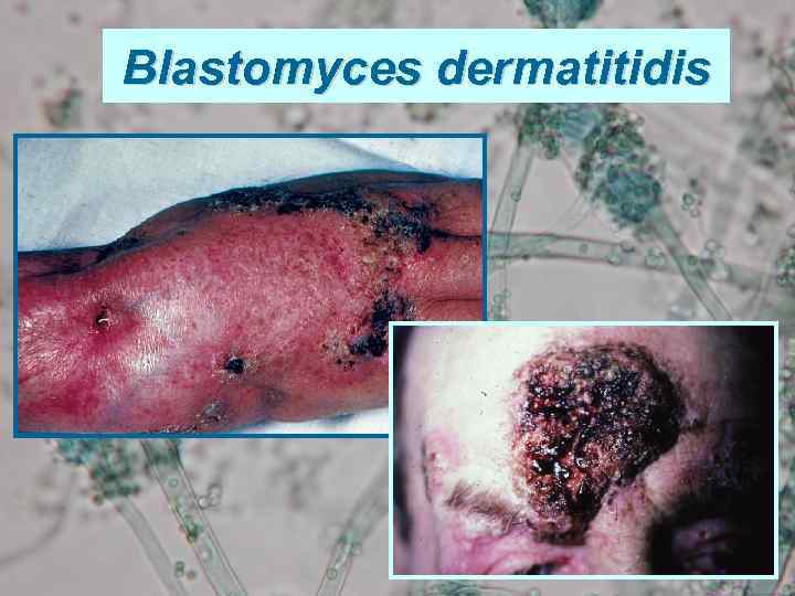 Blastomyces dermatitidis 