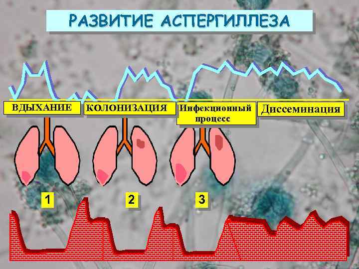 РАЗВИТИЕ АСПЕРГИЛЛЕЗА ВДЫХАНИЕ 1 КОЛОНИЗАЦИЯ 2 Инфекционный процесс 3 Диссеминация 