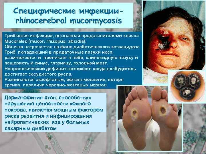 Специфические инфекцииrhinocerebral mucormycosis Грибковая инфекция, вызванная представителями класса Мucorales (mucor, rhizopus, absidia). Обычно встречается