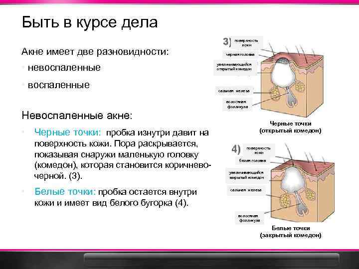 Acne is Not an Option Science & Signs of Acne Clearskin Professional Быть в