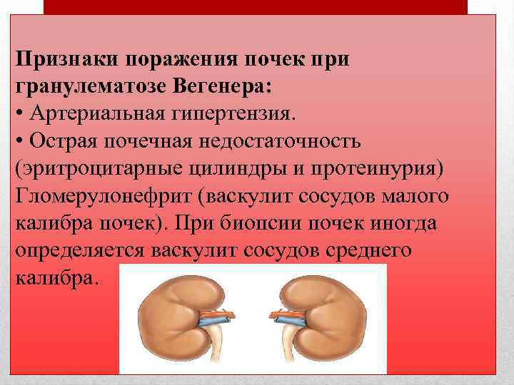 Признаки поражения почек при гранулематозе Вегенера: • Артериальная гипертензия. • Острая почечная недостаточность (эритроцитарные