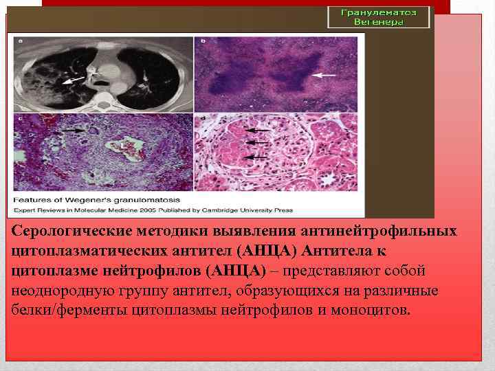 Серологические методики выявления антинейтрофильных цитоплазматических антител (АНЦА) Антитела к цитоплазме нейтрофилов (АНЦА) – представляют