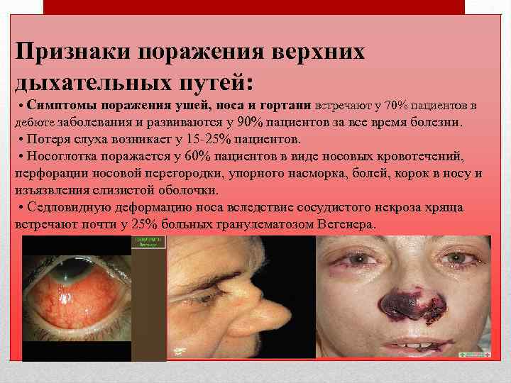 Признаки поражения верхних дыхательных путей: • Симптомы поражения ушей, носа и гортани встречают у