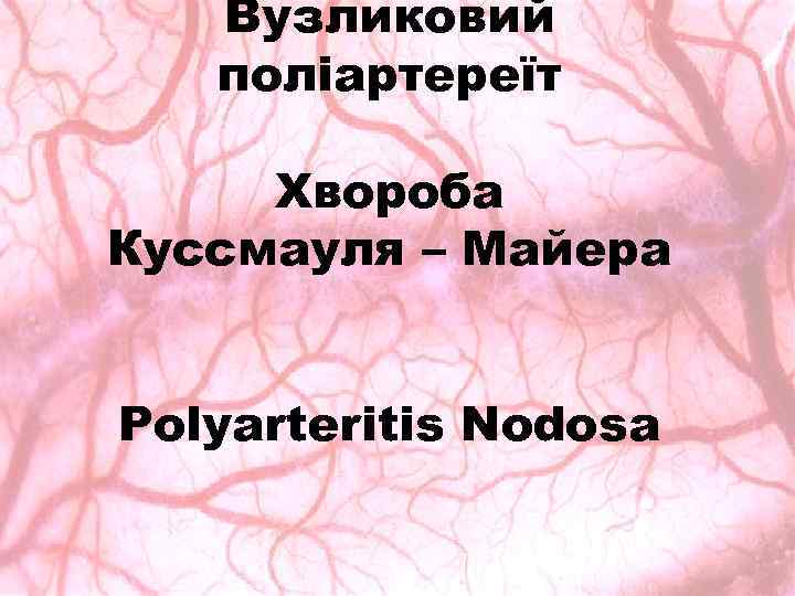 Вузликовий поліартереїт Хвороба Куссмауля – Майера Polyarteritis Nodosa 