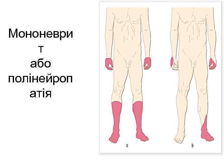 Мононеври т або полінейроп атія 