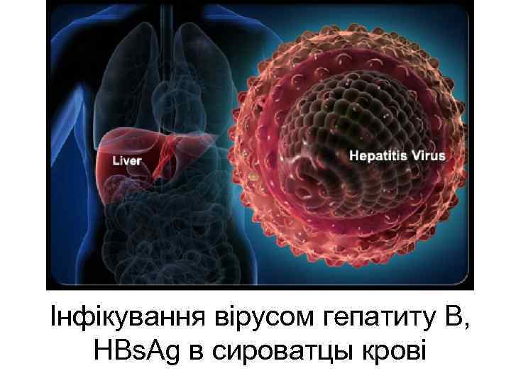 Інфікування вірусом гепатиту В, HBs. Ag в сироватцы крові 