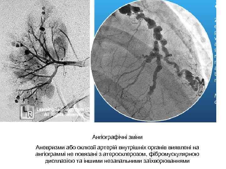 Ангіографічні зміни Аневризми або оклюзії артерій внутрішніх органів виявлені на ангіограммі не повязані з