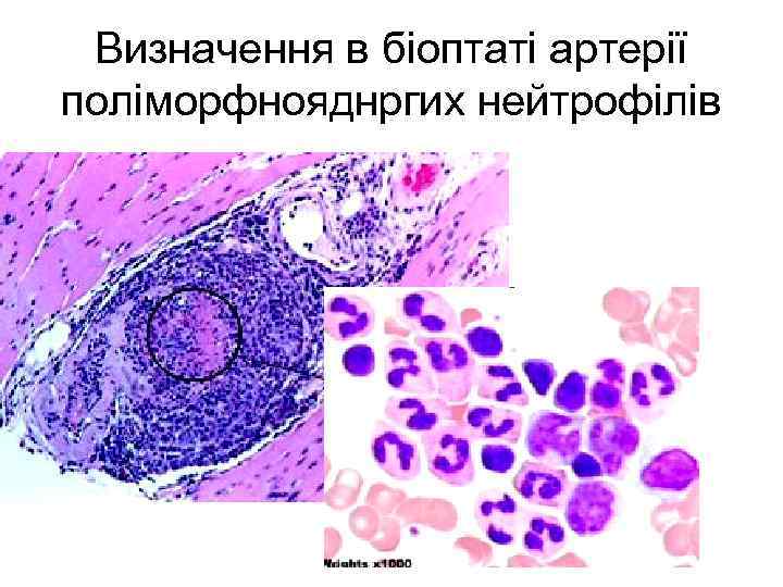 Визначення в біоптаті артерії поліморфнояднргих нейтрофілів 