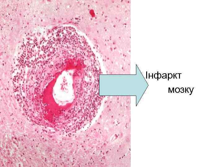 Інфаркт мозку 