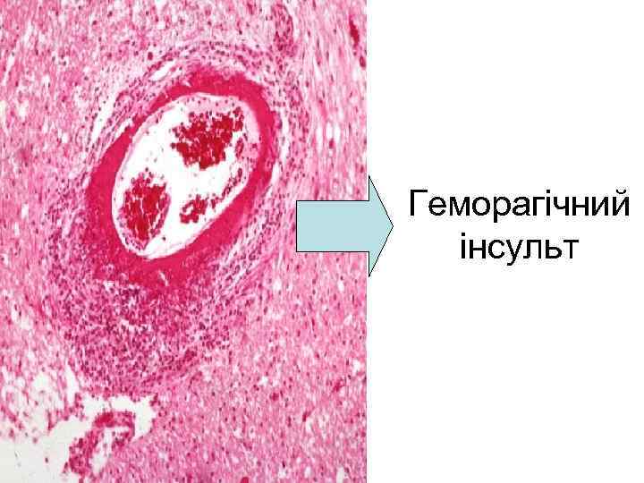 Геморагічний інсульт 