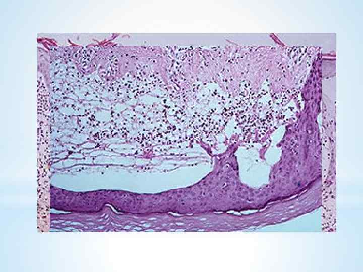 *При дерматите Дюринга гистологически выявляются подэпидермально расположенные пузыри и пузырьки, которые в ряде случаев