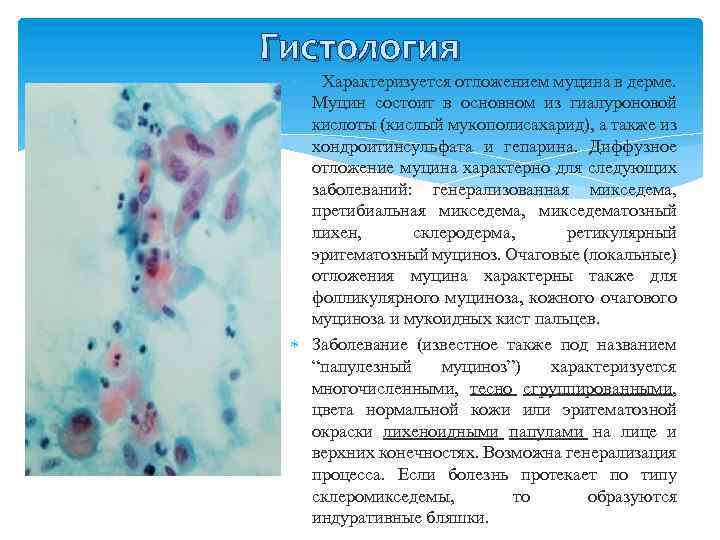 Гистология Характеризуется отложением муцина в дерме. Муцин состоит в основном из гиалуроновой кислоты (кислый