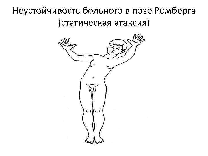 Неустойчивость больного в позе Ромберга (статическая атаксия) 