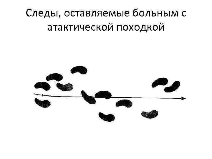Следы, оставляемые больным с атактической походкой 