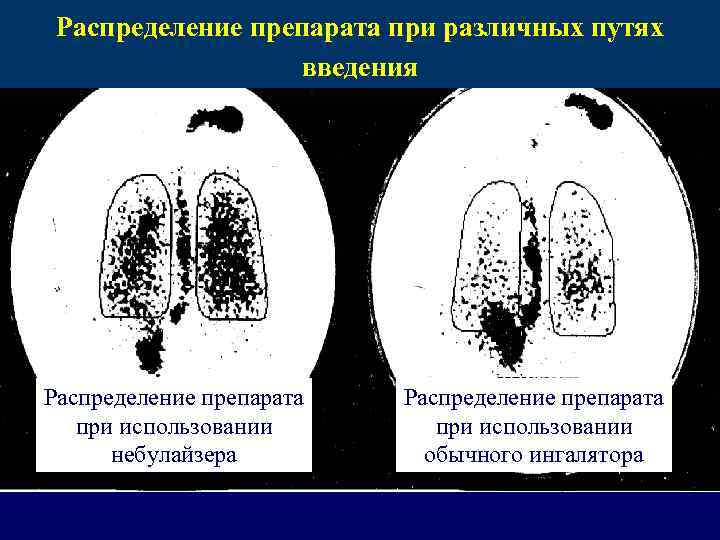 Распределение препарата при различных путях введения Распределение препарата при использовании небулайзера Распределение препарата при