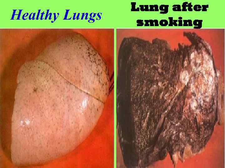 Healthy Lungs Lung after smoking 