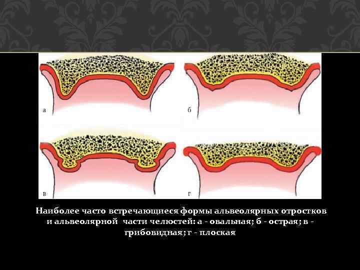  Наиболее часто встречающиеся формы альвеолярных отростков и альвеолярной части челюстей: а - овальная;