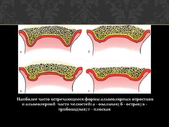 Слизистая альвеолярного отростка нижней челюсти. Формы вестибулярного ската альвеолярного отростка верхней челюсти. Форма гребня альвеолярного отростка. Формы вестибулярного ската альвеолярных отростков. Формы ската альвеолярного отростка.