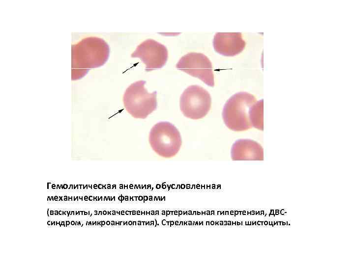 Анемия кома. Гемолитическая анемия акантоциты. Гемолитическая анемия мазок крови. Кровь при гемолитической анемии. Гемолиз эритроцитов гистология.