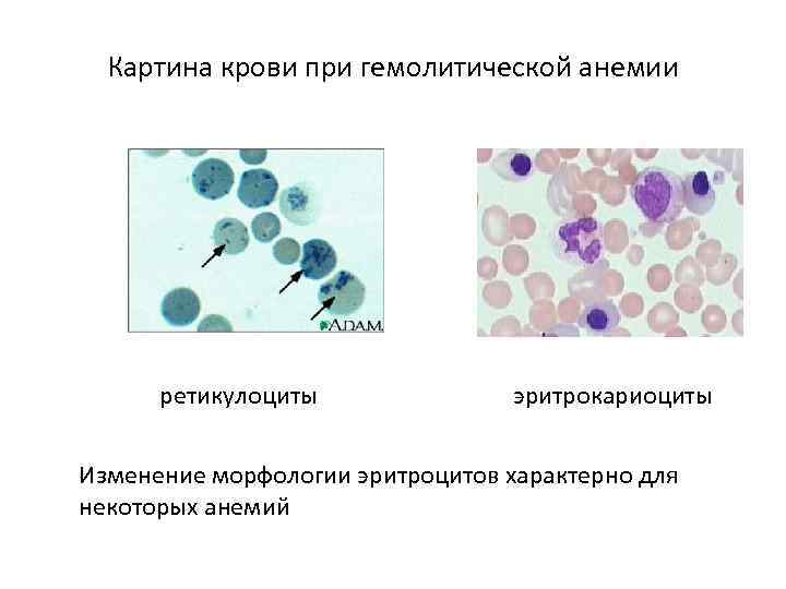 Повышение ретикулоцитов в крови. Ретикулоциты анализ крови анемия. Ретикулоциты при гемолитической анемии. Агрегатные ретикулоциты. Ретикулоциты 2.7.