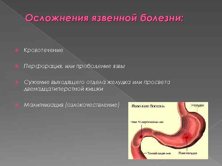 Осложнения язвенной болезни: Кровотечение Перфорация, или прободение язвы Сужение выходящего отдела желудка или просвета