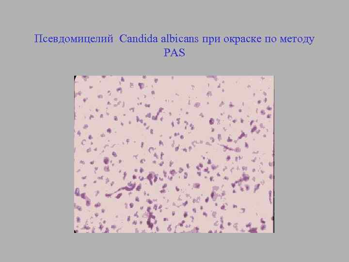 Псевдомицелий Candida albicans при окраске по методу PAS 