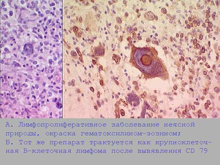 А. Лимфопролиферативное заболевание неясной природы, окраска гематоксилином-эозином; Б. Тот же препарат трактуется как крупноклеточная