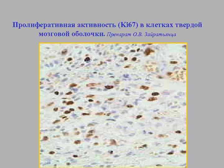 Пролиферативная активность (Ki 67) в клетках твердой мозговой оболочки. Препарат О. В. Зайратьянца 