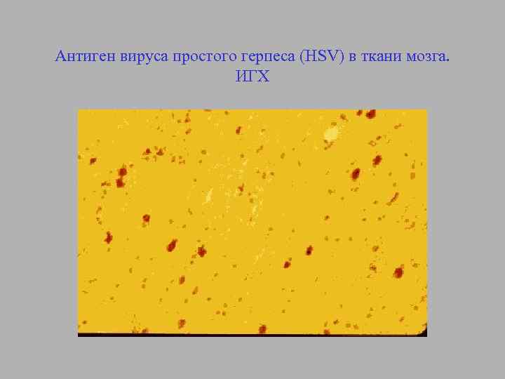 Антиген вируса простого герпеса (HSV) в ткани мозга. ИГХ 