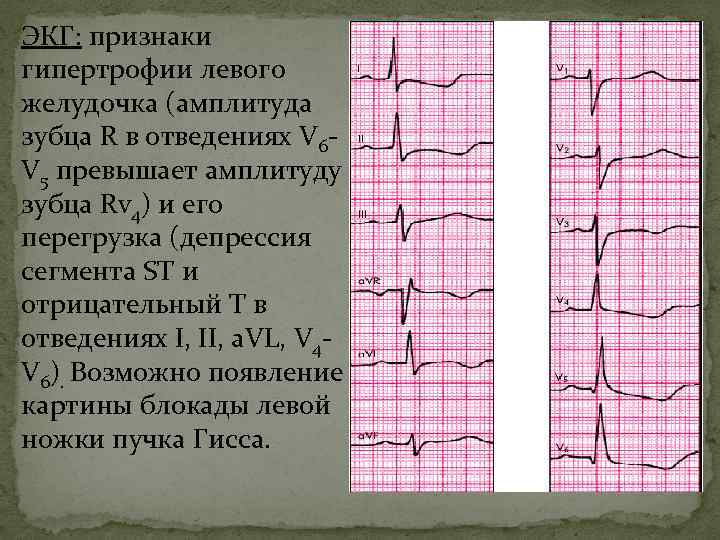 Депрессия st отрицательный