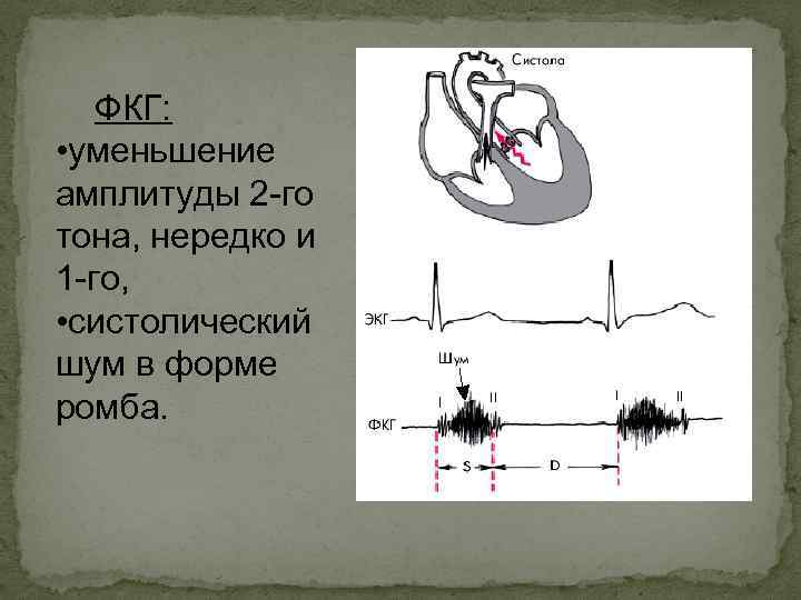 ФКГ: • уменьшение амплитуды 2 -го тона, нередко и 1 -го, • систолический шум