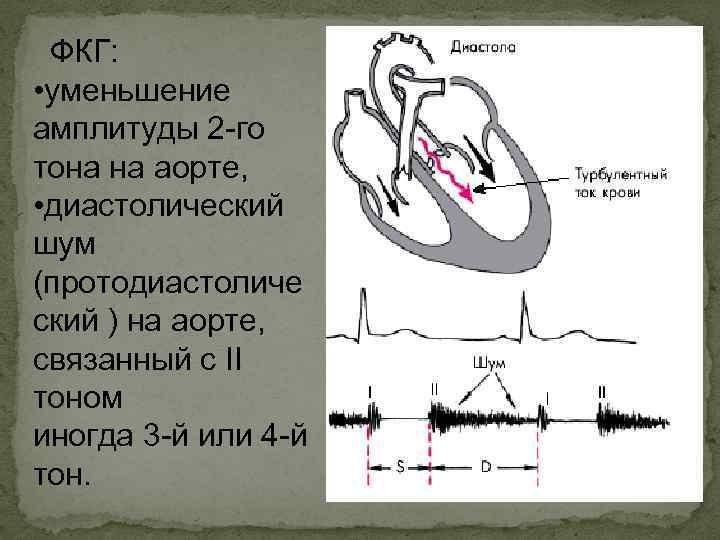 ФКГ: • уменьшение амплитуды 2 -го тона на аорте, • диастолический шум (протодиастоличе ский