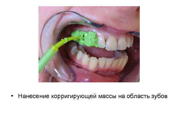  • Нанесение корригирующей массы на область зубов 