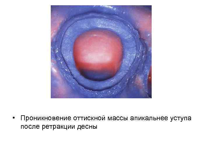  • Проникновение оттискной массы апикальнее уступа после ретракции десны 