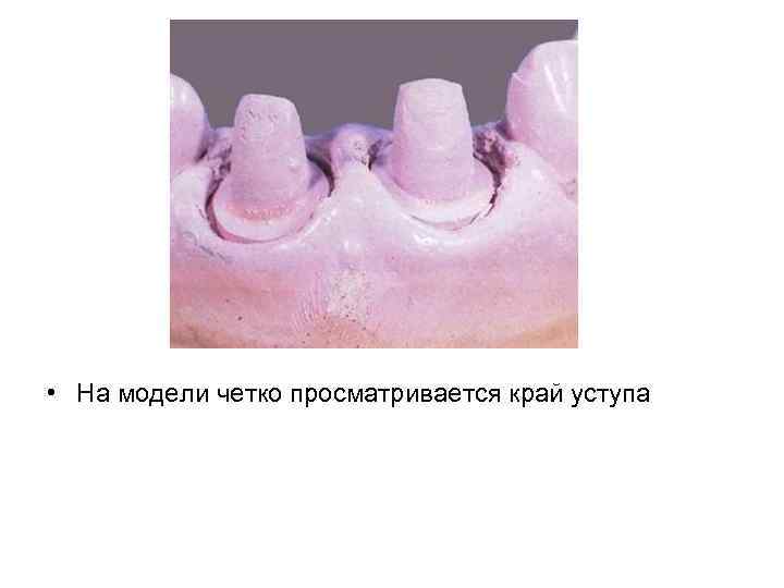  • На модели четко просматривается край уступа 