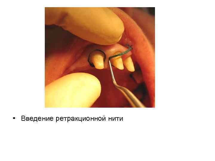  • Введение ретракционной нити 